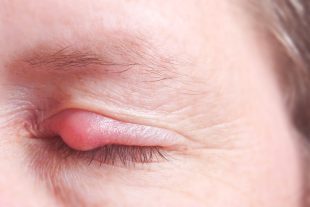 Gerstenkorn-Infektion am Augenlid